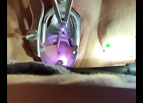 Evil intent of cervix with sound tenaculum