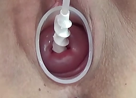 Milf cervix insertion with spiral catheter for insemination and vibrator jav extreme